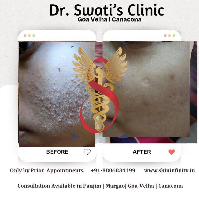 MNRF before after skin treatment goa