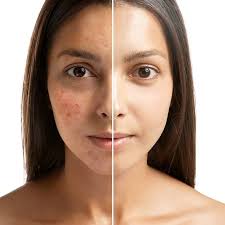 micropigmentation