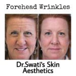 Botox and dermal fillers results at Dr Swati's Aesthetic clinic