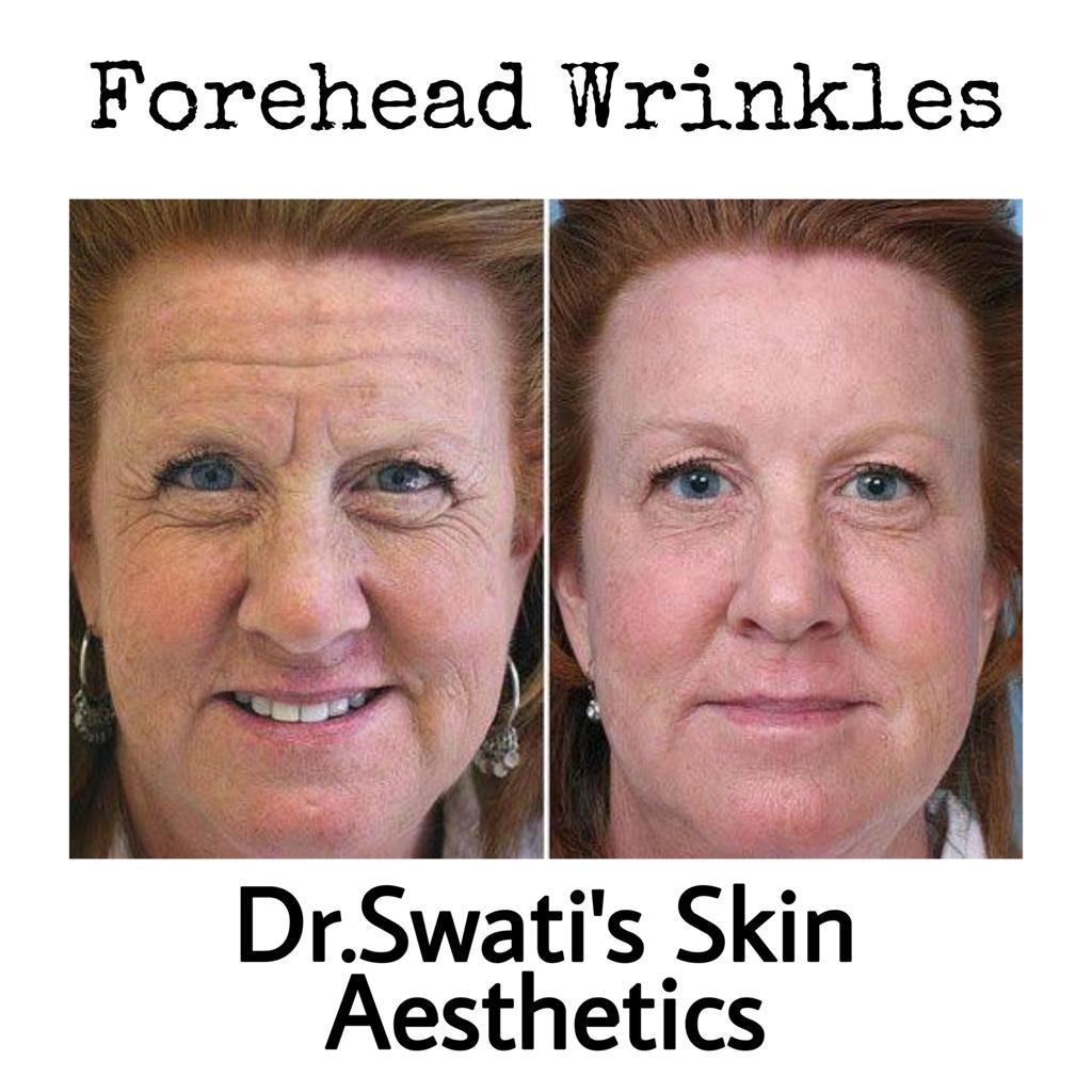 Botox and dermal fillers results at Dr Swati's Aesthetic clinic