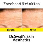 Botox and dermal fillers results at Dr Swati's Aesthetic clinic