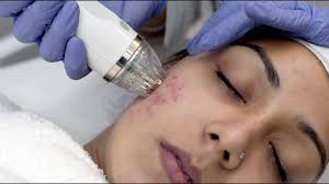 MNRF Treatment at Dr. Swati's Aesthetic Clinic