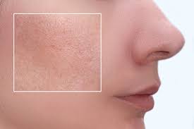pore reduction at Dr. Swati's Aesthetic Clinic
