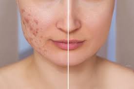 Acne scar treatment at Dr. Swati's Aesthetic Clinic