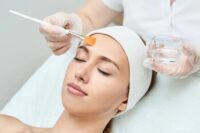 chemical peel