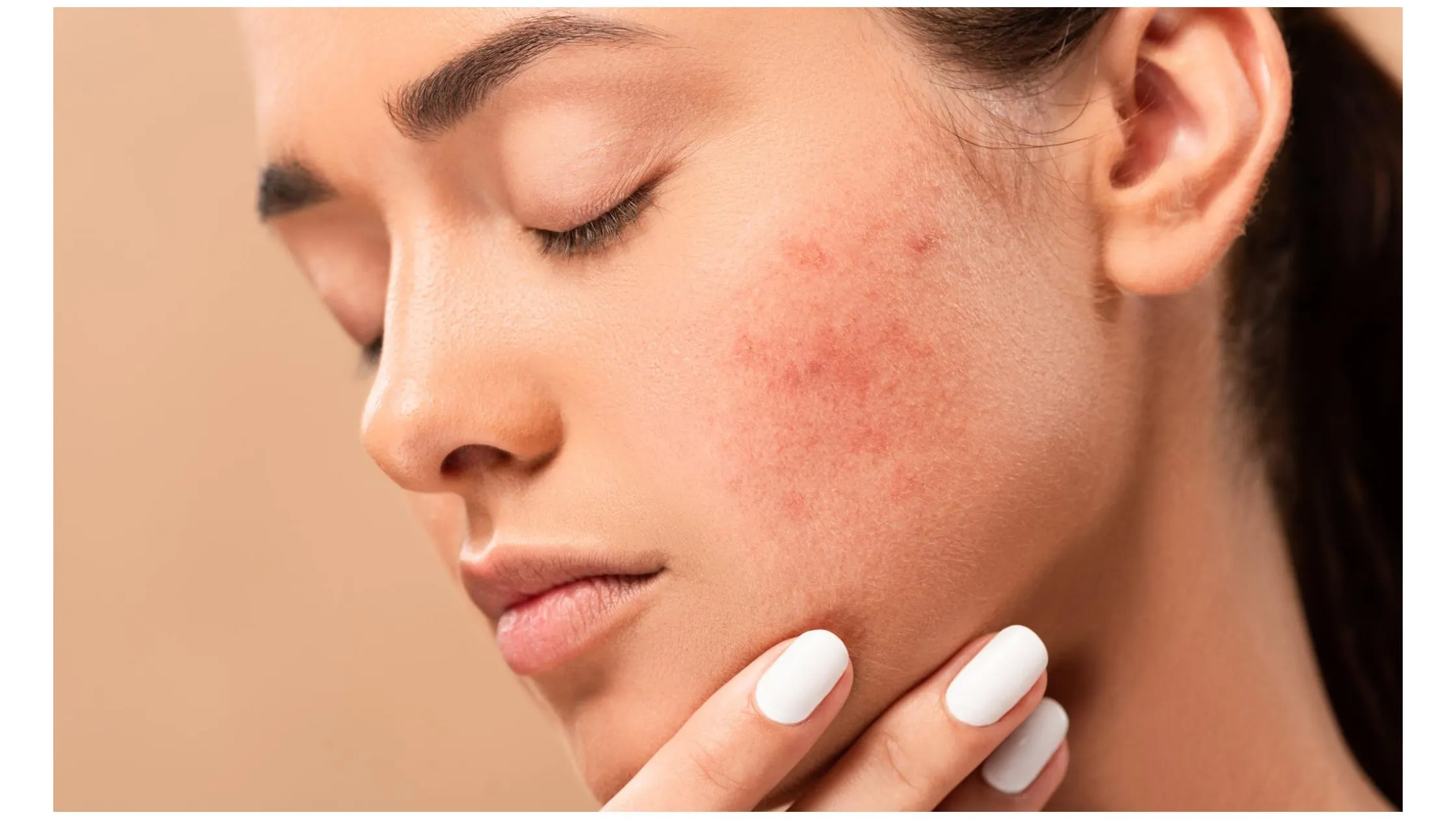 acne scar