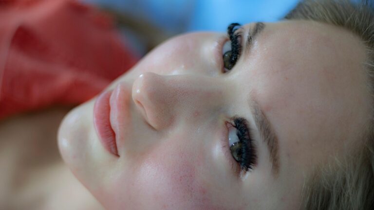 melasma and pigmentation treatment by Dr. Swati