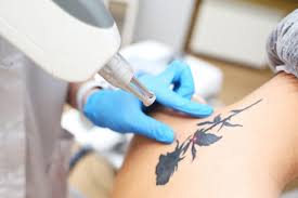 laser tattoo removal at Dr. Swati's Clinic, laser tattoo removal Goa