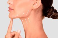 neckline botox