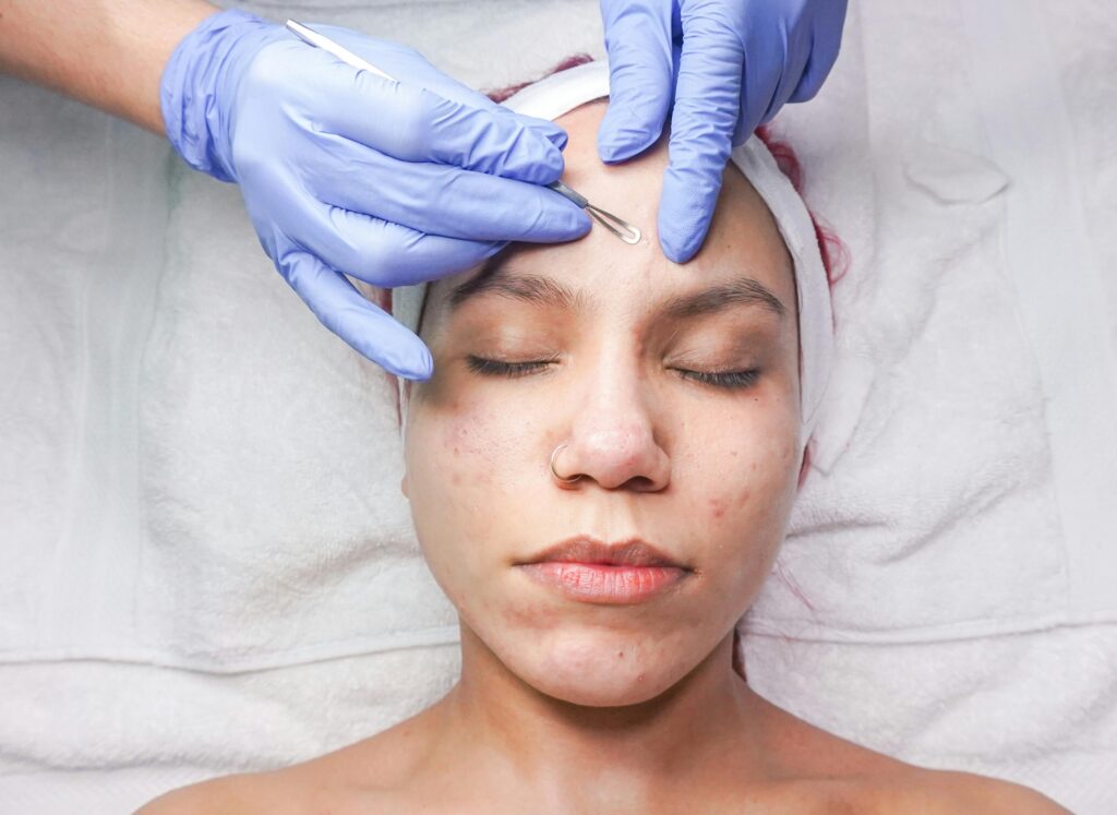acne treatment at Dr. Swati's Clinic