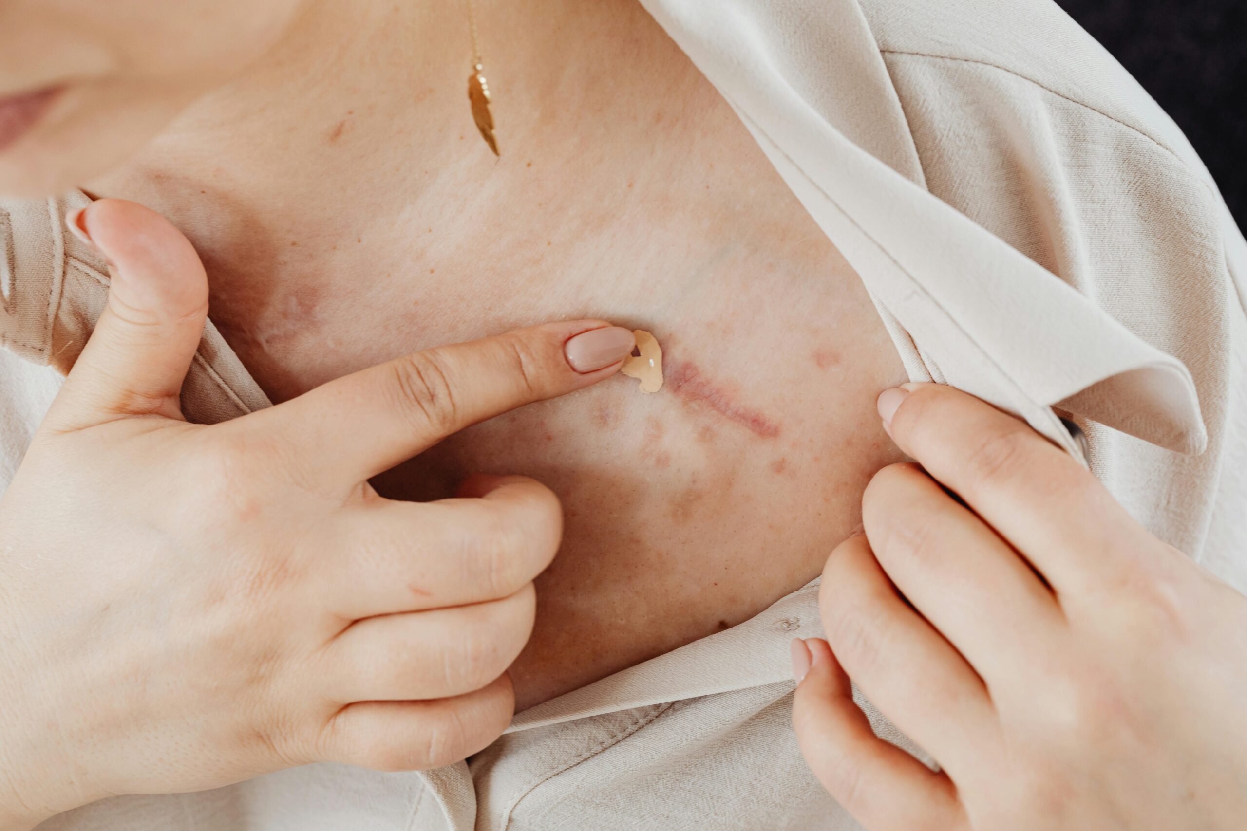 surgical scar