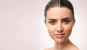 advanced scar treatment : MNRF and fractional laser
