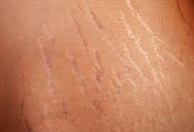 strech marks