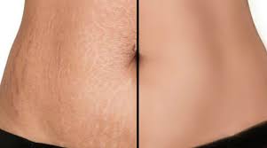 advanced stretch marks treatment at dr. Swati's clinic - stretch marks removal Goa
