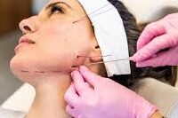 face thread lift