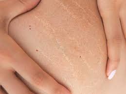 strech marks