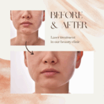 Dr Swati's aesthetic before after 68