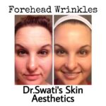 Dr Swati's aesthetic before after 70