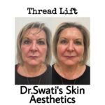 Dr Swati's aesthetic before after 62