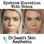 Dr Swati's aesthetic before after 61