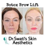Dr Swati's aesthetic before after 59