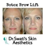 Dr Swati's aesthetic before after 58
