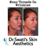 Dr Swati's aesthetic before after 56