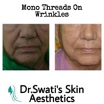 Dr Swati's aesthetic before after 55