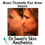 Dr Swati's aesthetic before after 54