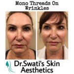 Dr Swati's aesthetic before after 53