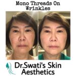 Dr Swati's aesthetic before after 52