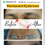 Dr Swati's aesthetic before after 49