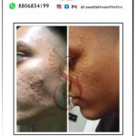 Dr Swati's aesthetic before after 47