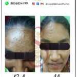 Dr Swati's aesthetic before after 45