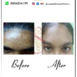 Dr Swati's aesthetic before after 44