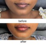 Dr Swati's aesthetic before after 42