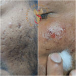 Dr Swati's aesthetic before after 40
