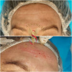 Dr Swati's aesthetic before after 39