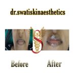 Dr Swati's aesthetic before after 29