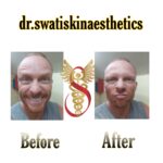 Dr Swati's aesthetic before after 29