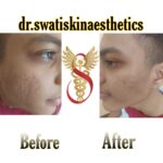Dr Swati's aesthetic before after 26
