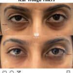 Dr Swati's aesthetic before after 19