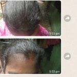 Dr Swati's aesthetic before after 17