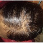 Dr Swati's aesthetic before after 16