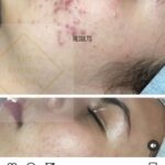 Dr Swati's aesthetic before after 15
