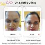 Dr Swati's aesthetic before after 8