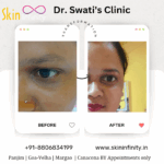 Dr Swati's aesthetic before after 7