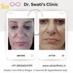 Dr Swati's aesthetic before after 6