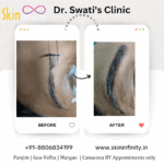 Dr Swati's aesthetic before after 5