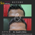 Dr Swati's aesthetic before after 4